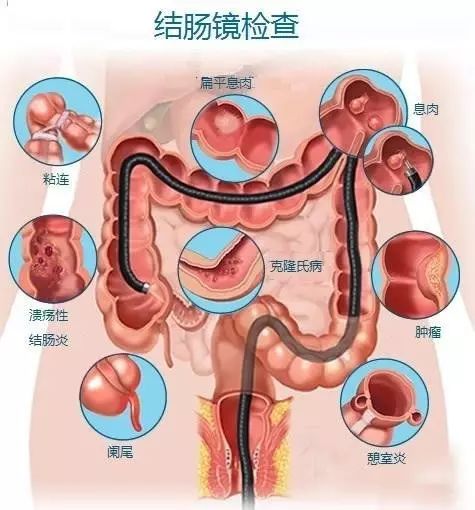 北大外科专家罗成华:哪些人应定期做结肠镜?