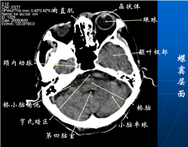 头颅ct怎么看图解正常图片