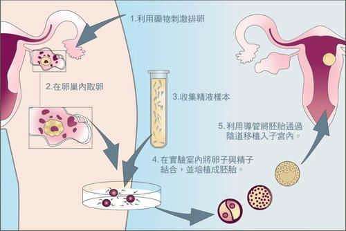 試管嬰兒的流程它的具體流程是: