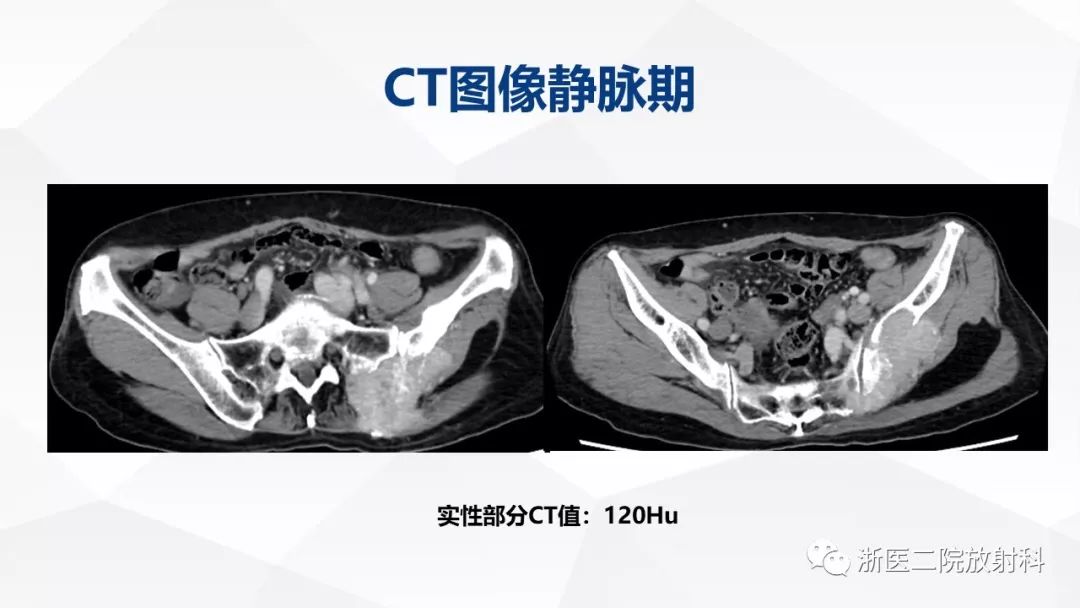 骨肌組病例及解析 | 浙醫二院病例討論會(第四期)_徐雷鳴