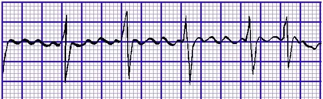 心电图特征无正常p波,代之连续的粗齿状f波