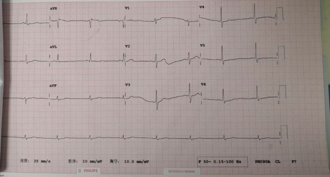高血压冠脉造影左主干未见明显狭窄病变;左前降支近中段原支架植入处