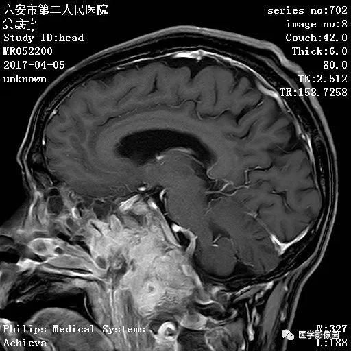 鼻咽鳞状细胞癌图片