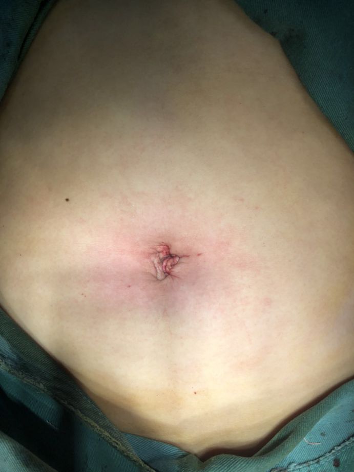 女人节育手术伤口图片图片