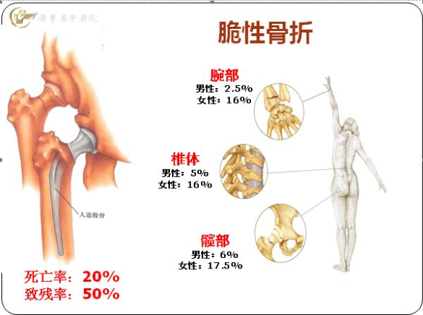 骨小梁只能撐起兔子,如果增加它的重量,就會發生斷裂,也就是脆性骨折