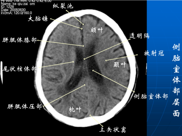 头颅ct断层解剖讲解图片