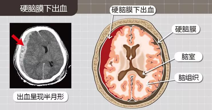 颅内血肿分类图片图片