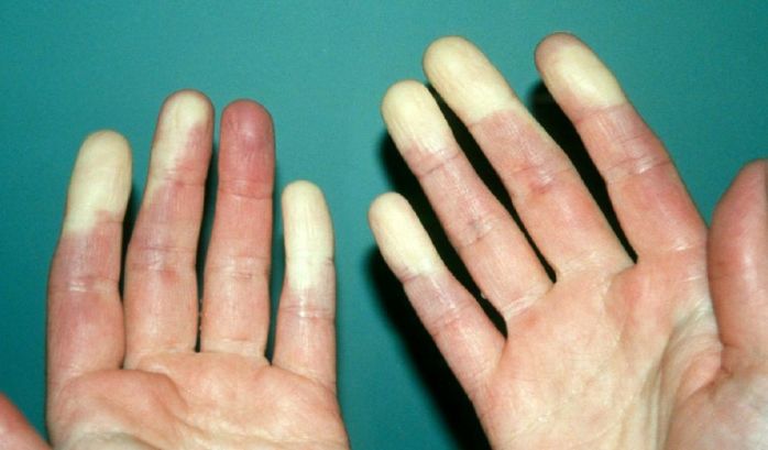 雷诺现象,是指手指或脚趾遇冷或受到刺激后发白,发紫,发红的变化过程