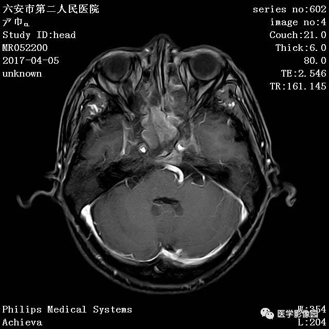 鼻咽鳞状细胞癌图片