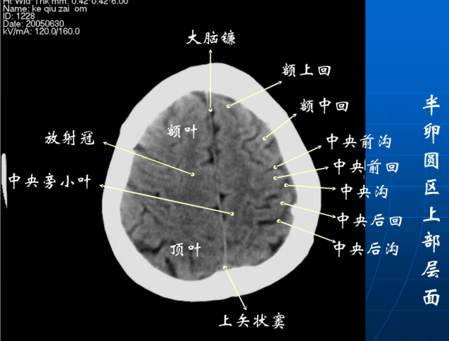 头颅正位片解剖图片