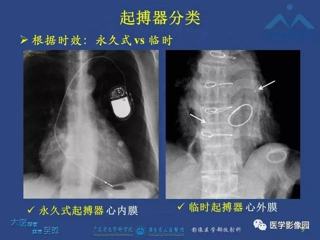 心臟起搏器植入術後放射科醫師需要知道的胸部x線表現影像天地