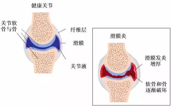 膝关节积液肿胀医用三氧疗法轻松缓解关节疼痛腿疼不求人