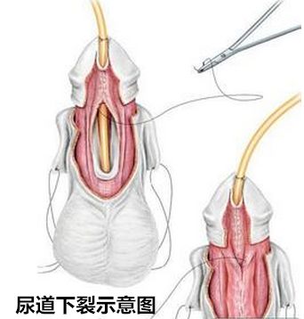 尿道口狭窄的症状图片图片