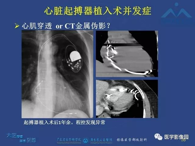 心臟起搏器植入術後放射科醫師需要知道的胸部x線表現影像天地