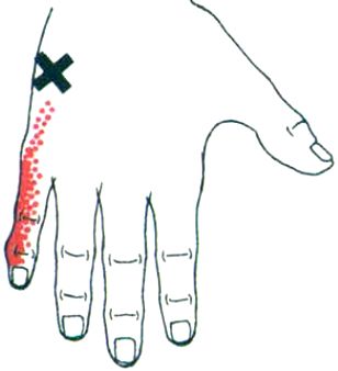 激痛点疗法——小指展肌