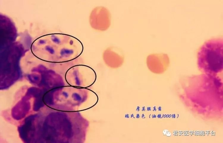 隐球菌病理图片