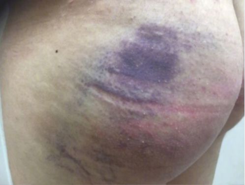 虐殴50次16岁男团遭工作人员暴打致全身发紫受伤照触目惊心