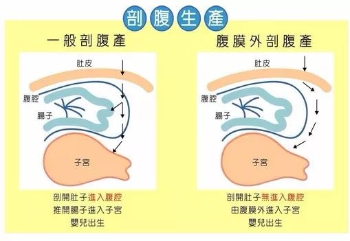 剖宫产膀胱腹膜反折图片