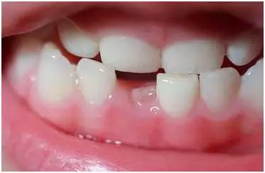 导致部分甚至全部占据,以致恒牙错位萌出或埋伏阻生而形成牙颌畸形