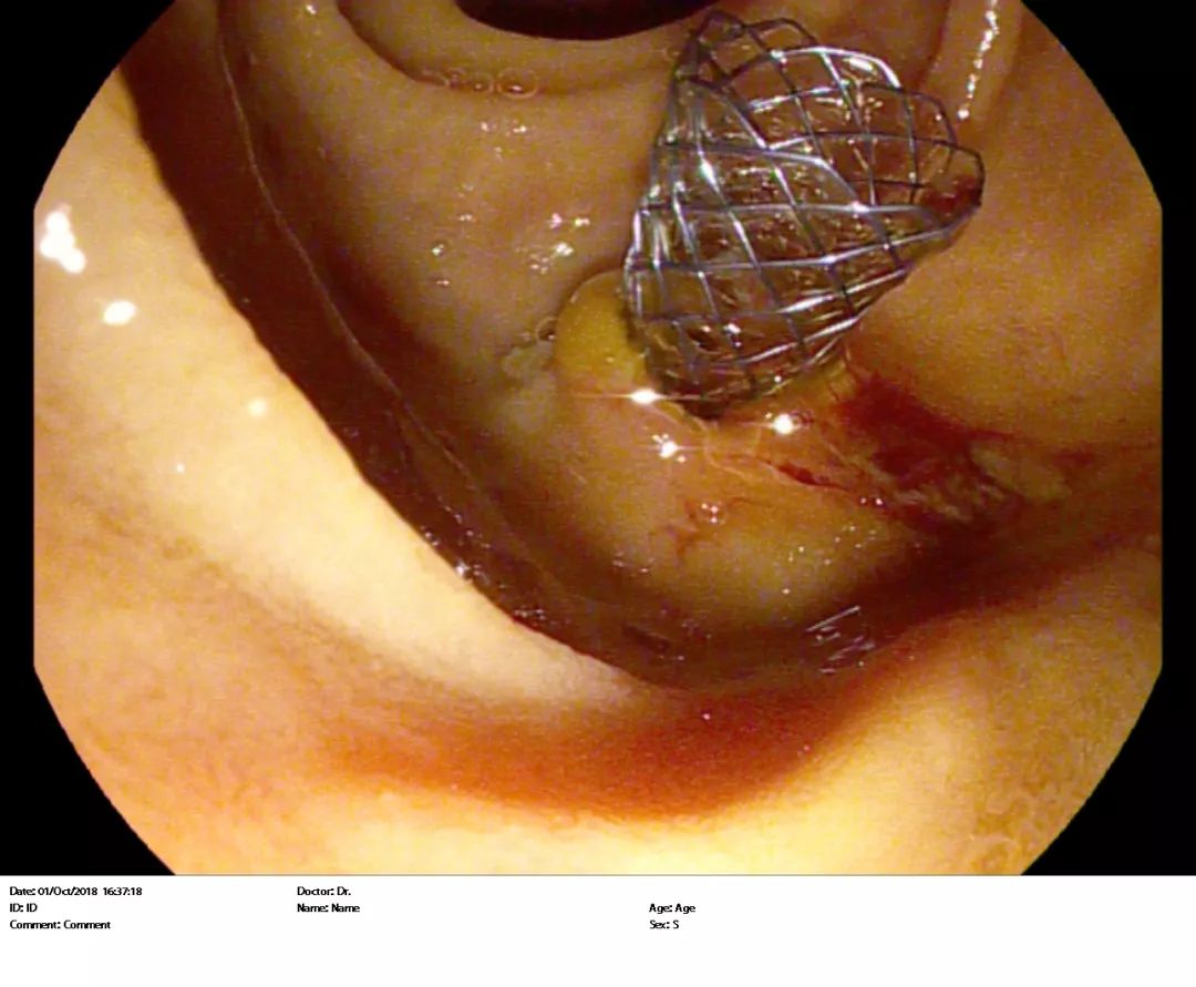 胆管支架图片