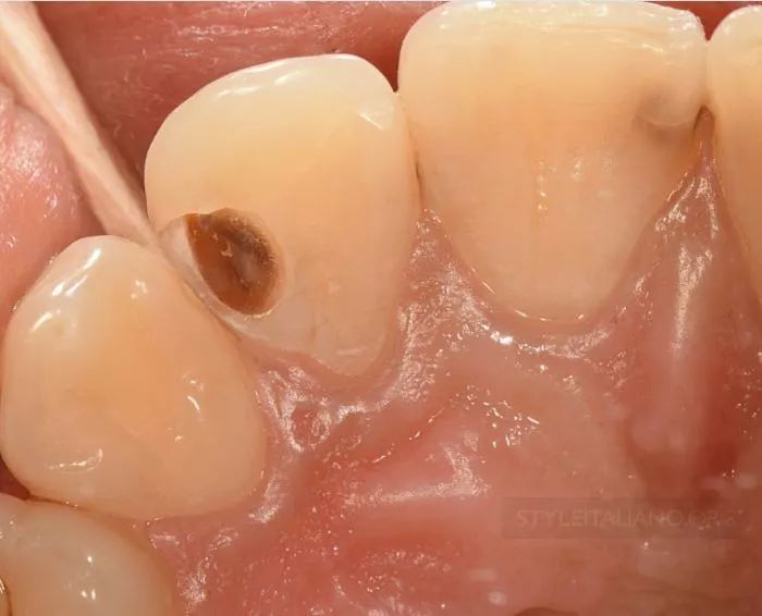 接触点重建,当然还有龋洞的深度,和可能会影响的牙髓活力
