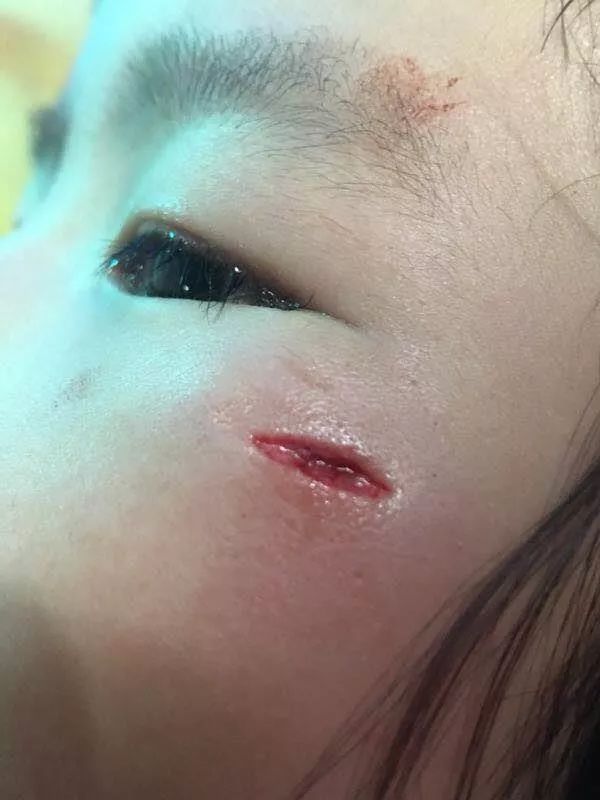 目前,小吴脸部的伤口已经拆线,但是留下了疤痕