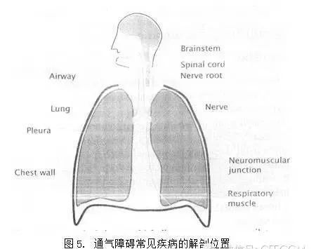 胸壁異常:脊柱後側凸,強直性脊柱炎,胸膜纖維化等呼吸肌肉功能障礙:肌