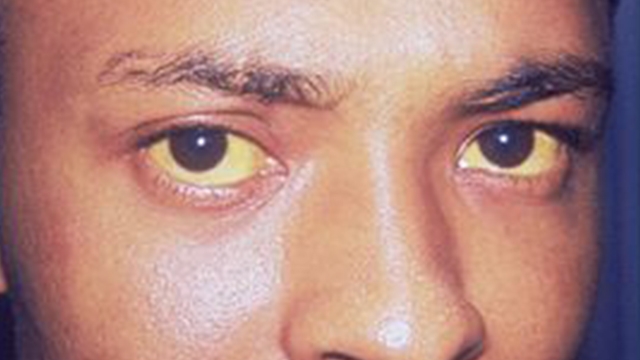 肝炎的人好好看看自己眼睛有了2个变化是肝病加重了
