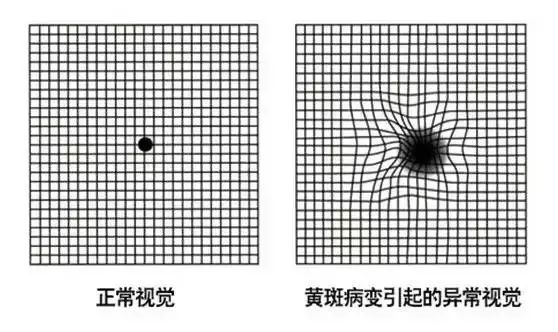 自测黄斑病变 