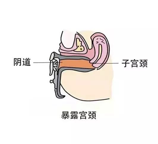 女性走进妇产科,医生大多数都会进行妇科检查,当用窥阴器置于阴道之