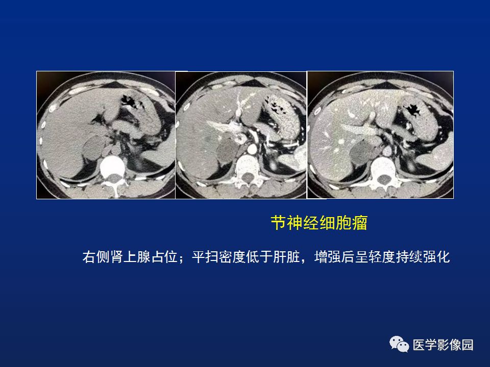 肾上腺疾病的影像学表现影像天地