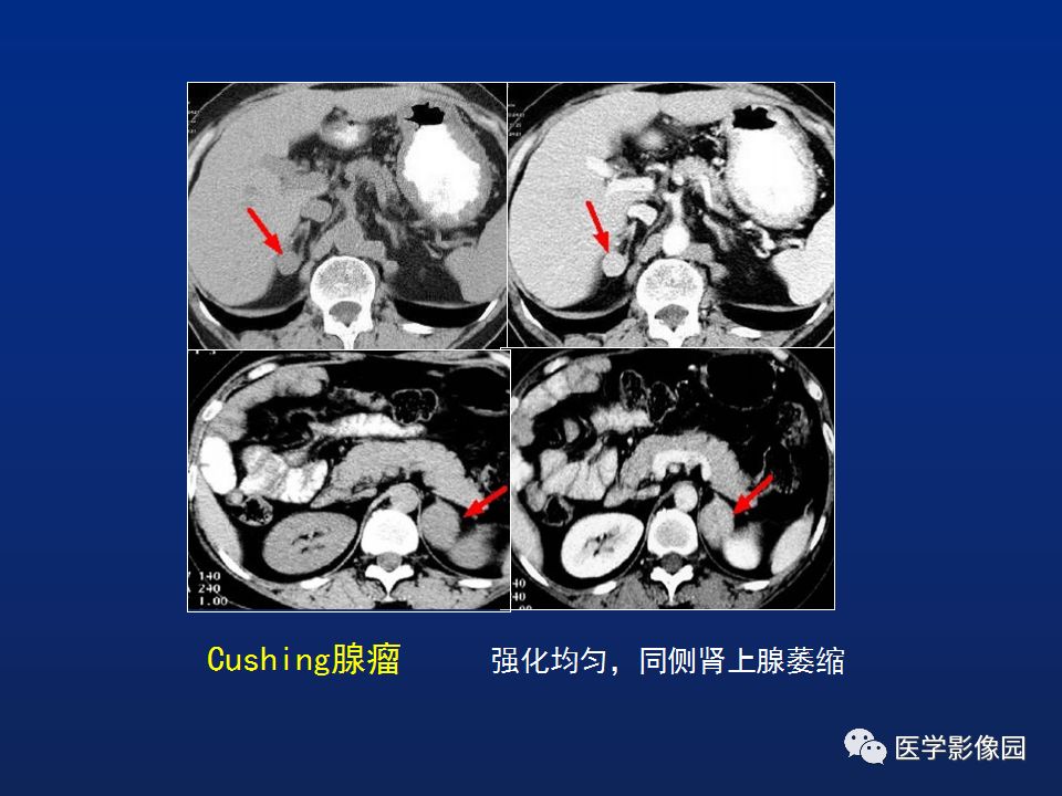 肾上腺疾病的影像学表现影像天地