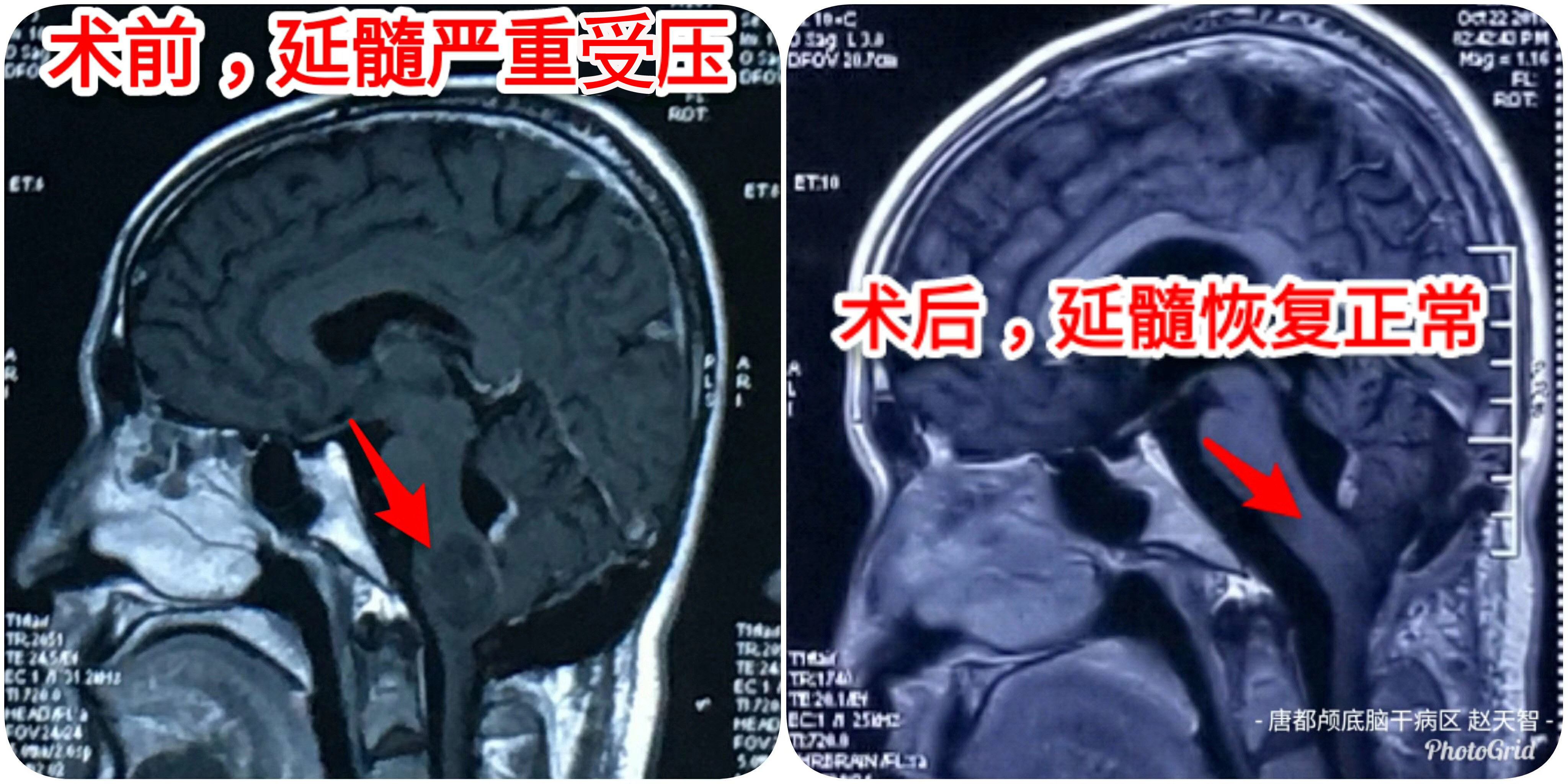 延髓瘤图片