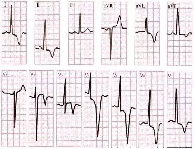 急性腦病心電圖示意圖