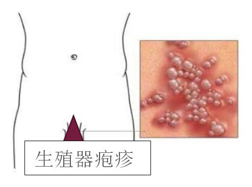 外阴疱疹是怎么引起图片