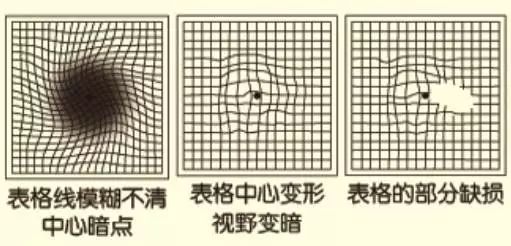 自测黄斑病变一张图搞定