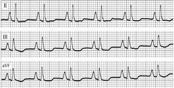 右心房肥大的心电图图片