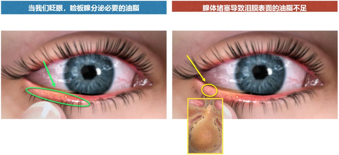 睑板腺挤压分泌物图片图片