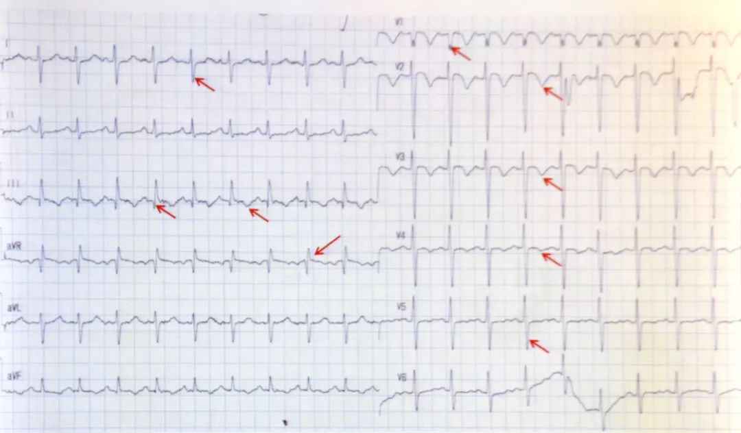 肺栓塞的心电图s1q3t3图片