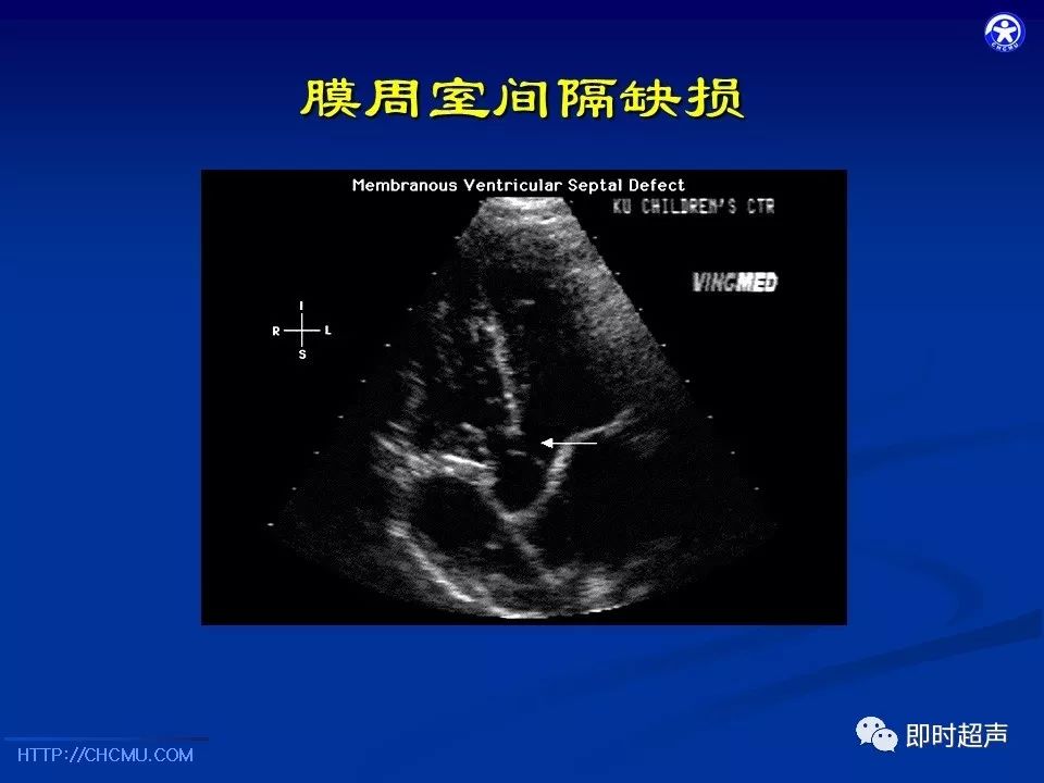 小儿先天性心脏病超声心动图检查