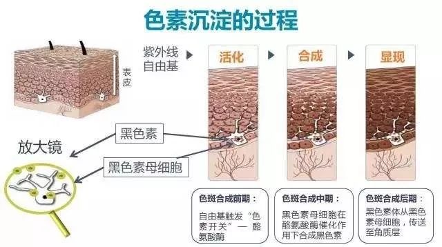 你对脸上的斑点都不了解,怎能做到正确祛斑呢?_形成