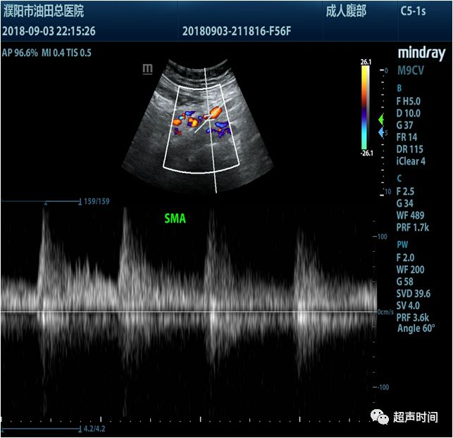 多年腹痛:超声发现病因竟然是一根血管