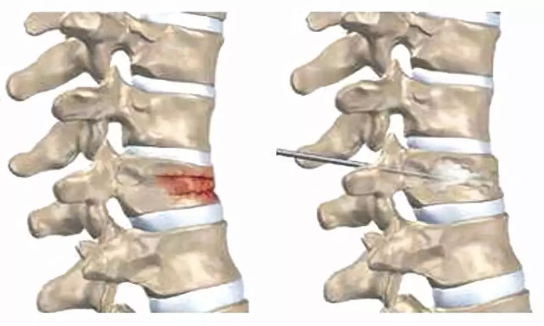 腰椎骨质疏松性压缩性骨折是好发于老年人的一种椎体的脆性骨折