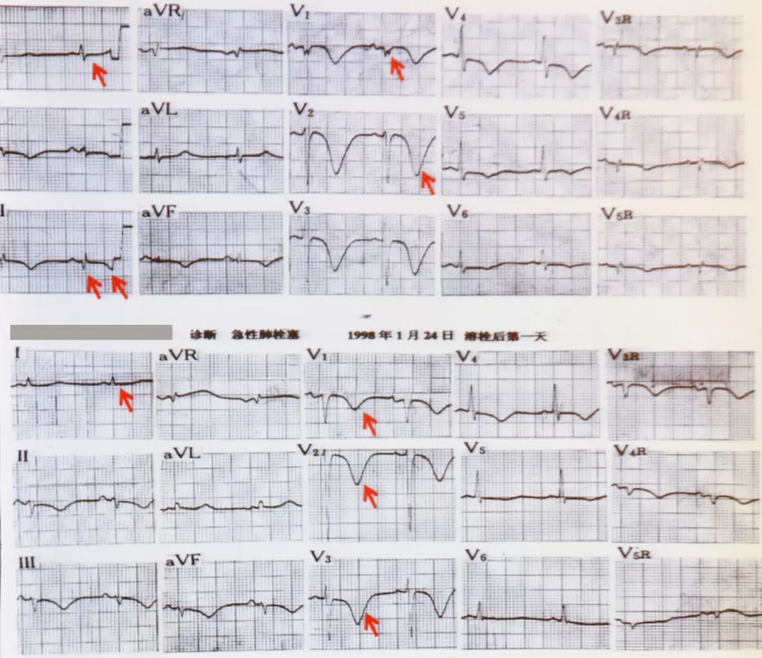 心电图3s征诊断标准图片