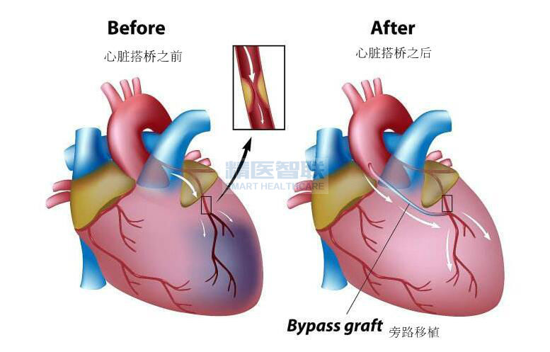 心脏搭桥手术是大型手术