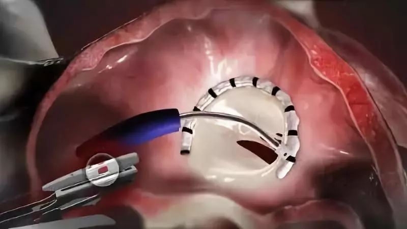 经皮肤置换和修复心脏瓣膜mitral and tricuspid valve percutaneous