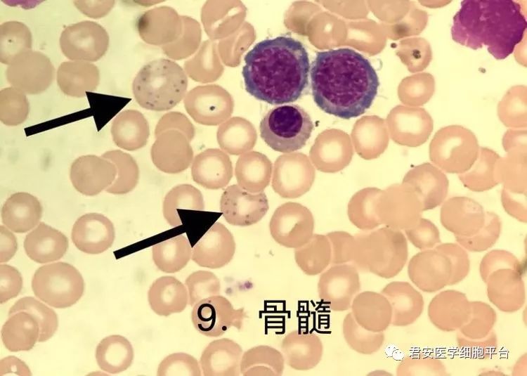 ▼「嗜碱性点彩红细胞」形态特征:红细胞内出现大小不等,多少不一的深