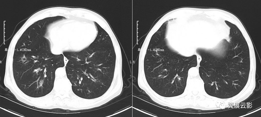 氣道侵襲性肺麴黴菌病airwayinvasiveaspergllosis