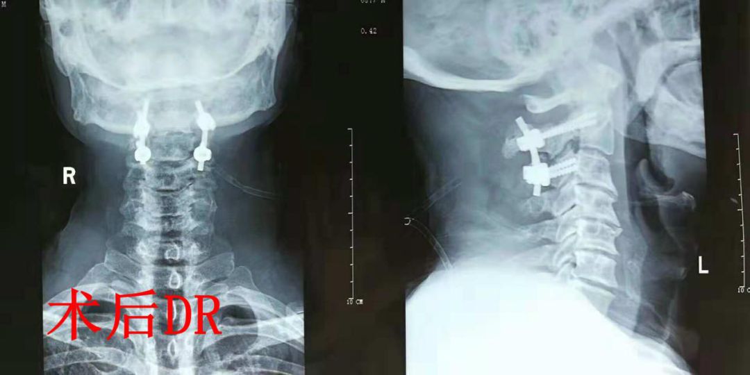 医疗我院骨伤二科成功救治一例hangman骨折创伤性枢椎滑脱患者
