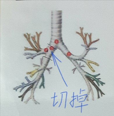 肺癌患者肺部切除後有哪些症狀_手術